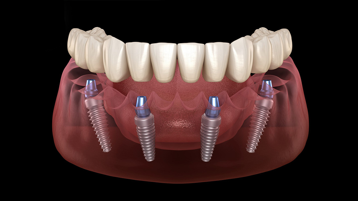 All-on-4 fogpótlás: új mosoly négy implantátumon